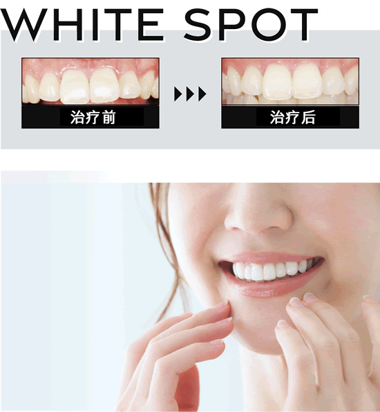 前牙白斑改善治疗
